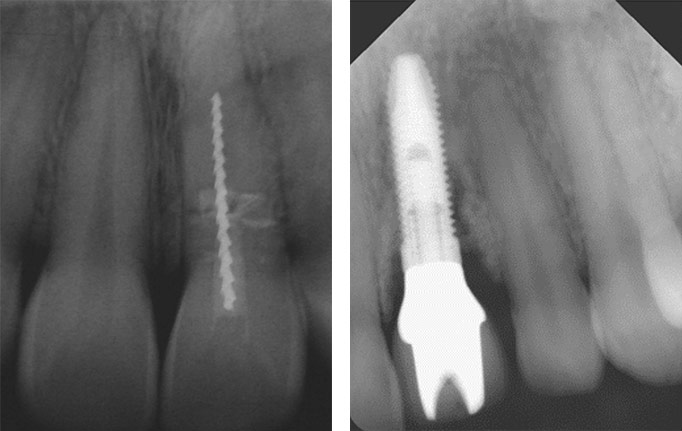 Frontzahntrauma Frontzahntrauma