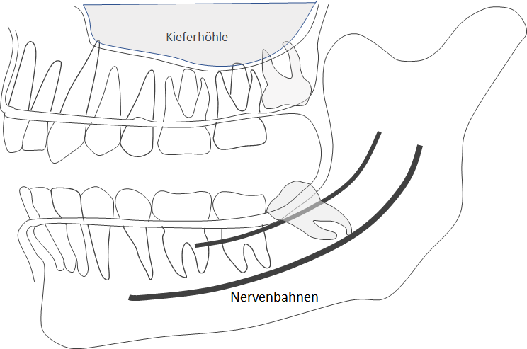 Osteotomie